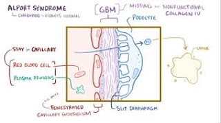 Alport syndrome: Video, Causes ...